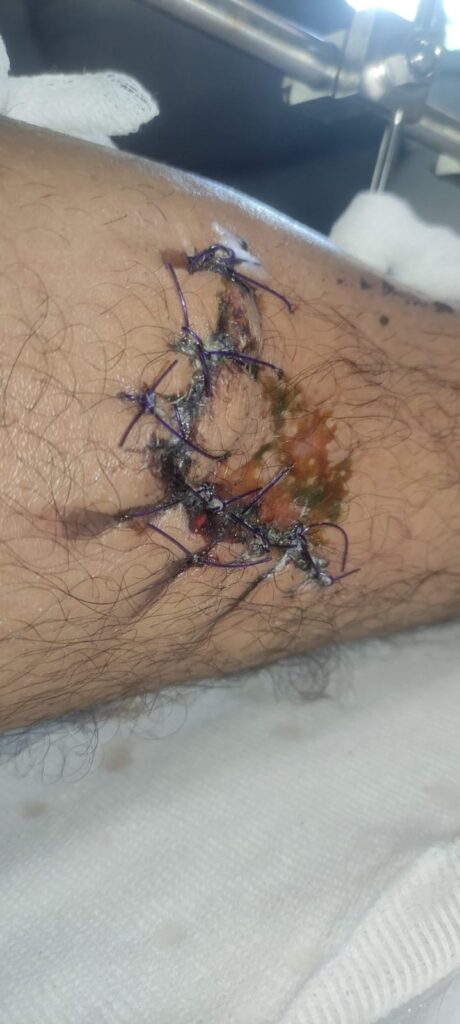 foto de colgajo suturado en pierna izquierda