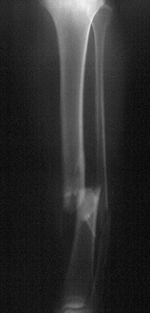 radiografia de fractura de tibia y peroné