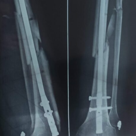 Imagen de Radiografía después de Cirugía de clavo intramedular