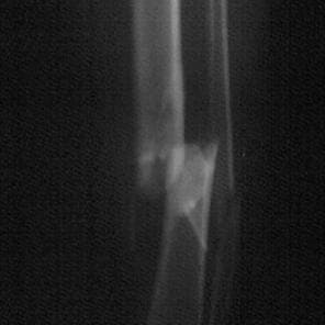 imagen de radiografía de una fractura en la tibia