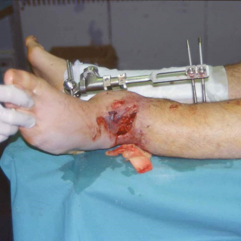 Imagen que muestra una pierna con fractura expuesta