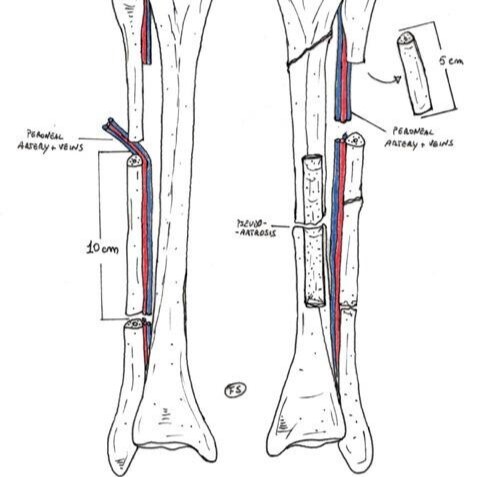imagen que muestra un ejemplo de injerto de huesos entre tibia y peroné
