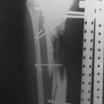 Imagen de radiografía en tibia y peroné, con visible fractura en tibia