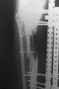 Imagen de radiografía en tibia y peroné, con visible fractura en tibia