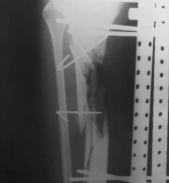 Imagen de radiografía en tibia y peroné, con visible fractura en tibia